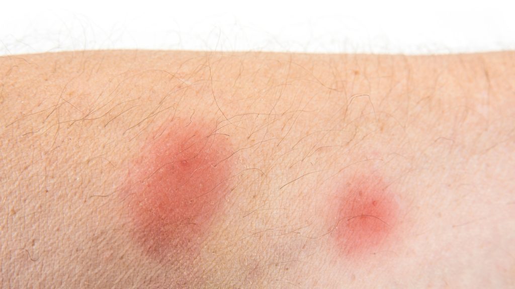 Are Bed Bug Bites Itchy Pest Samurai