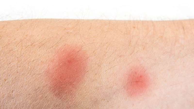 Is a Bed Bug Bite Painful