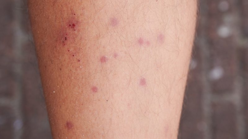 What Do Chigger Bites Look Like