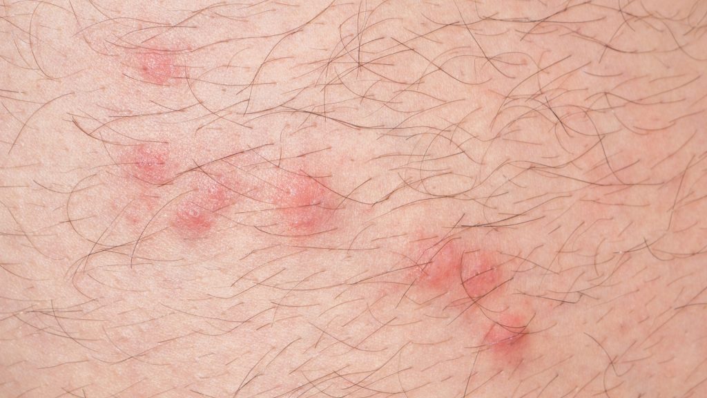 What Do Flea Bites Look Like on Humans