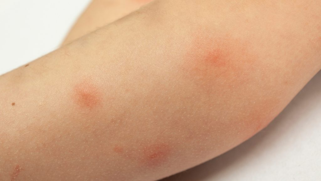 What Do Mosquito Bites Look Like