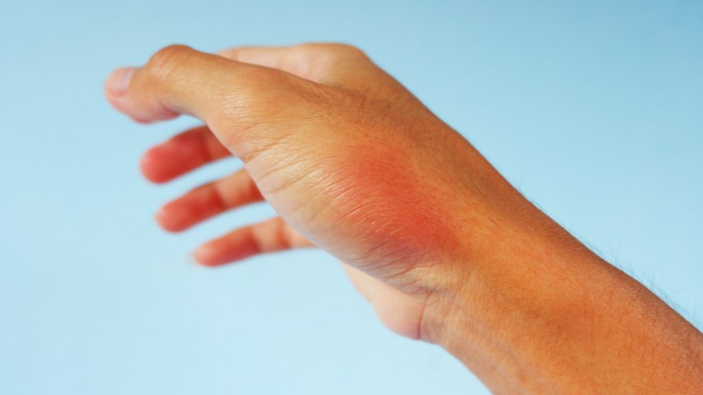 Symptoms of a Bad Reaction to Bites and Stings