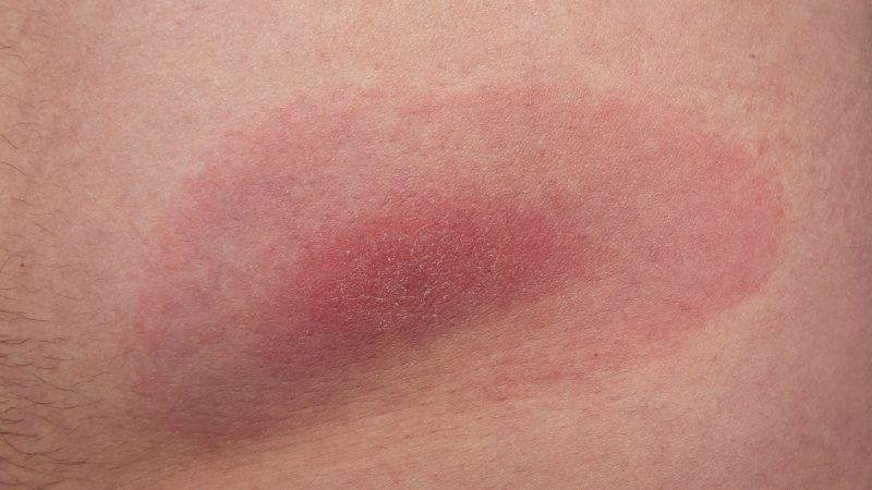 What Do Lone Star Tick Bites Look Like