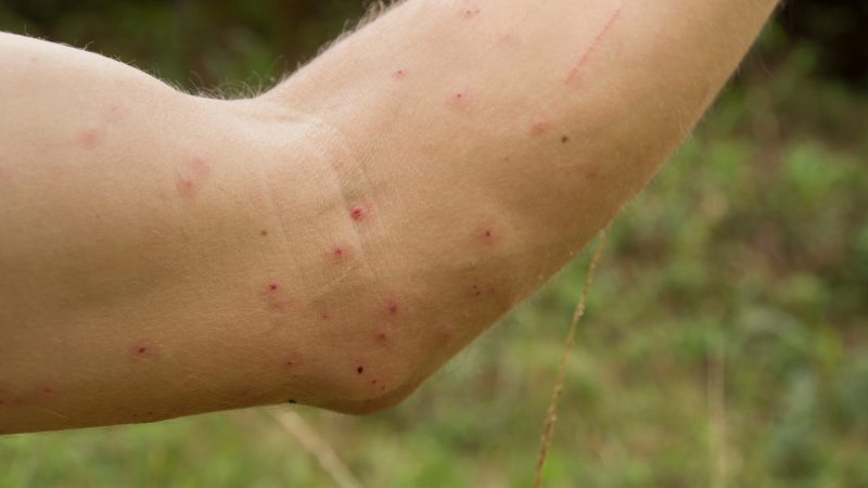 How Long Do Mosquito Bites Last