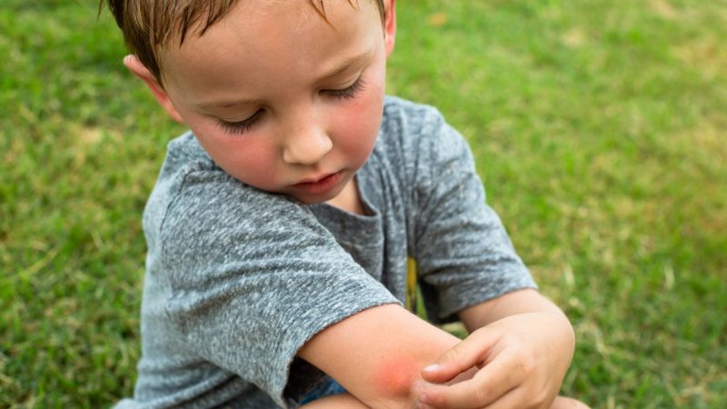 How to Tell Bed Bug Bites From Spider Bites