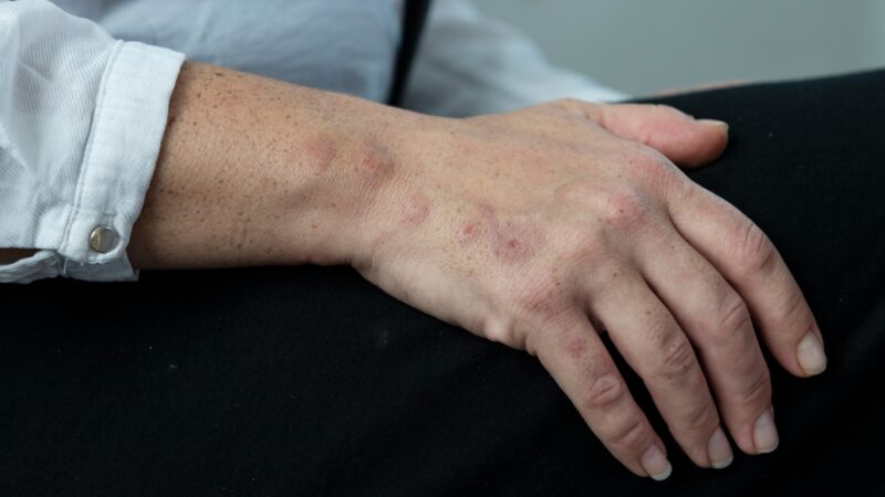 What Do Bed Bug Bites Look Like